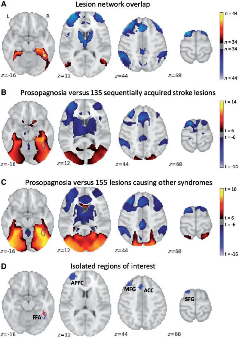 Figure 5 Connectivity to the right FFA and left frontal cortex is specific to lesions causing acquired prosopagnosia compared to control lesions and lesions causing other syndromes. Using our entire cohort of lesions causing prosopagnosia (n = 44), all lesion locations demonstrated positive and negative correlation to a specific set of locations (A). This pattern of connectivity was specific to lesions causing prosopagnosia compared to a large cohort of control lesions causing non-specific symptoms (B) or to lesions causing specific symptoms other than prosopagnosia (C). The conjunction of our sensitivity and specificity analyses (D) identified five locations including the right FFA, the left anterior prefrontal cortex (APFC), the left middle frontal gyrus (MFG), the dorsal anterior cingulate cortex (ACC), and the left superior frontal gyrus (SFG). In all images, the a priori right FFA region is shown as a blue outline.