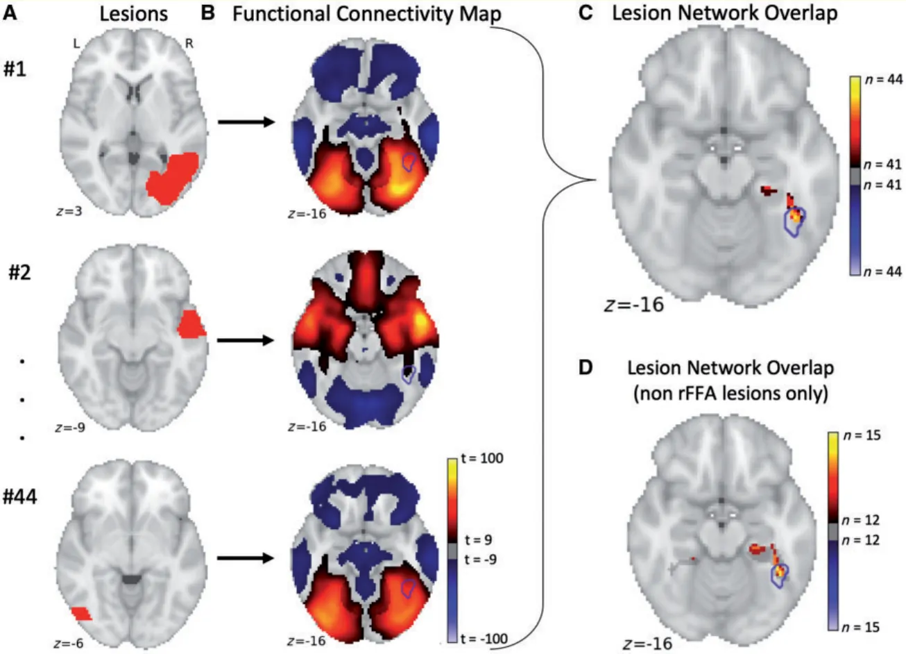 Figure 3 Lesion network mapping identified consistent regions connected to all lesions causing acquired prosopagnosia. Lesions were traced onto a standardized MNI brain template (A). Brain regions functionally connected to each lesion location were then obtained using a large resting state functional connectivity database (B). Overlap of thresholded functional connectivity maps (t 4 9) from each lesion identified brain regions connected to the greatest number of lesion locations (C). Of note, consistent connectivity to the right FFA was still observed from lesion locations that did not intersect the right FFA (D). In all images, the a priori right FFA region is shown as a blue outline.