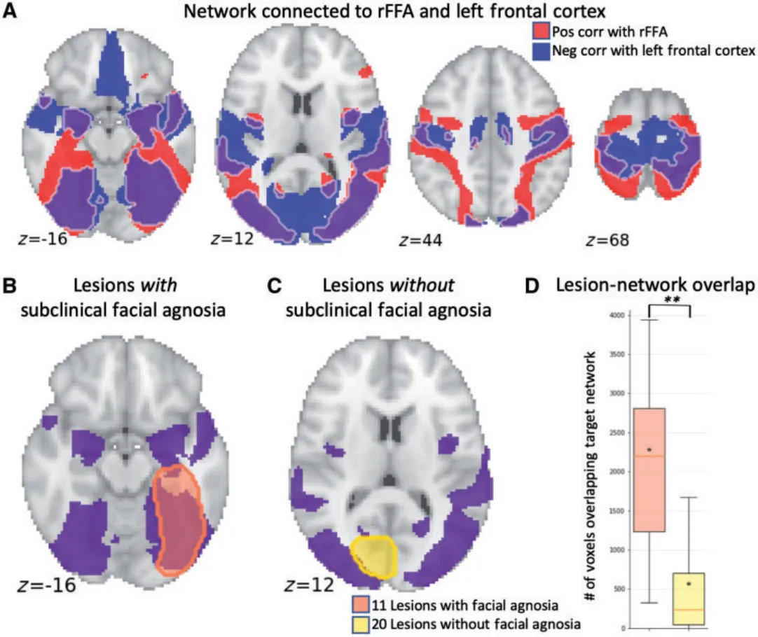 Figure 8 Lesion connectivity with the right FFA and left frontal cortex predicted subclinical facial agnosia. The intersection of positive connectivity with our identified right FFA (red shading) and negative connectivity with our left frontal regions (blue shading) defined a specific network of areas (purple shading) (A) highly likely to cause prosopagnosia if lesioned. Posterior cerebral artery strokes from an independent dataset that were associated with subclinical facial agnosia (B), versus lesions associated with intact facial perception (C), were significantly more likely to intersect this network (D). (P 5 0.01). Red lines in box-plots indicate medians while stars indicate means.