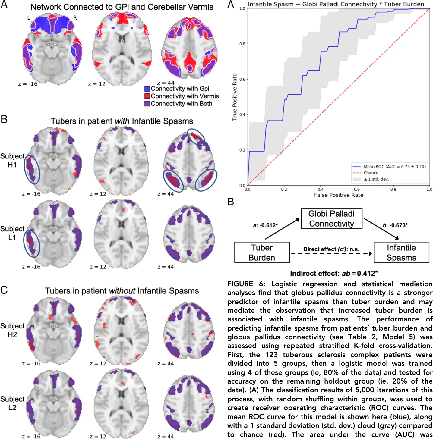 FIGURE 5: Lesion network connectivity with the bilateral globi pallidi and cerebellar vermis predicts locations where tubers are more likely to cause infantile spasms. (A) The intersection of connectivity with the globus pallidi (Gpi, blue shading) and connectivity with the cerebellar vermis (red shading) defined a specific network of areas (purple shading) predicted to be highly likely to cause infantile spasms if lesioned. (B, C) As a demonstration, the same 4 patients shown in Figure 2, 2 with infantile spasms and 2 without infantile spasms, and with either high or low tuber burden, are again shown here with tuber burden (in red) compared to the identified network (in purple). Among patients with infantile spasms (B), it can be seen that tubers are more likely to overlap with the predicted network (blue circles). Conversely, among patients without infantile spasms (C), tubers largely do not overlap with the predicted network.