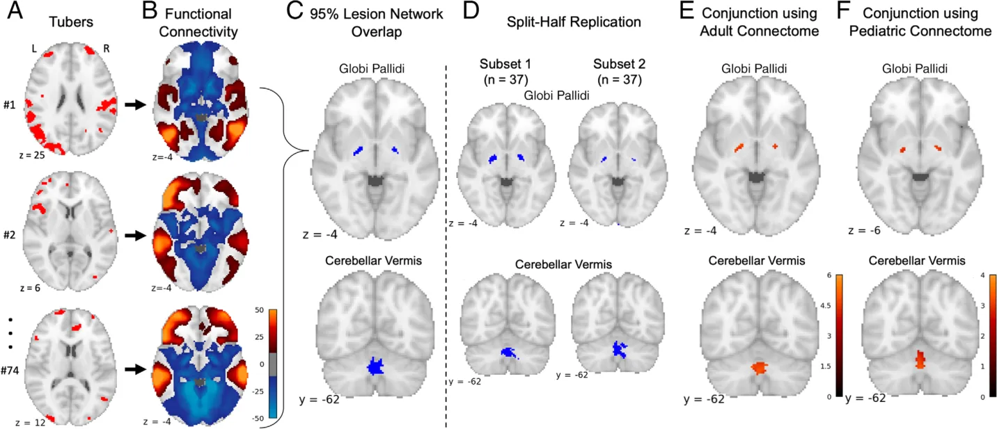 FIGURE 4: Lesion network mapping identified 3 brains regions with consistent negative functional connectivity to tuber distributions associated with infantile spasms. (A) The 74 tuber distributions associated with infantile spasms were registered to a standardized Montreal Neurological Institute brain template. (B) Brain regions functionally connected to each tuber distribution were identified using a large-scale functional connectivity database of young adult participants. (C) Overlap of these functional connectivity maps identified 3 brain regions connected to >95% of tuber distributions associated with infantile spasms: the left and right globus pallidus and the cerebellar vermis. (D) Consistent connected regions were also identified in 2 independent subsets. Of note, overlap of functional connectivity maps from the 49 children without infantile spasms did not reveal any consistently connected regions. Regions where connectivity was specific to infantile spasms were then identified by voxelwise 2-sample t test between children with infantile spasms and those without. (E) The conjunction of a mask of these significant voxels and the lesion network mapping analysis above generated a map of regions both sensitive and specific for infantile spams, here shown controlling for genetic etiology as a covariate. (F) This process was repeated with an alternate largescale functional connectivity database of 9-year-old participants identifying consistent results.