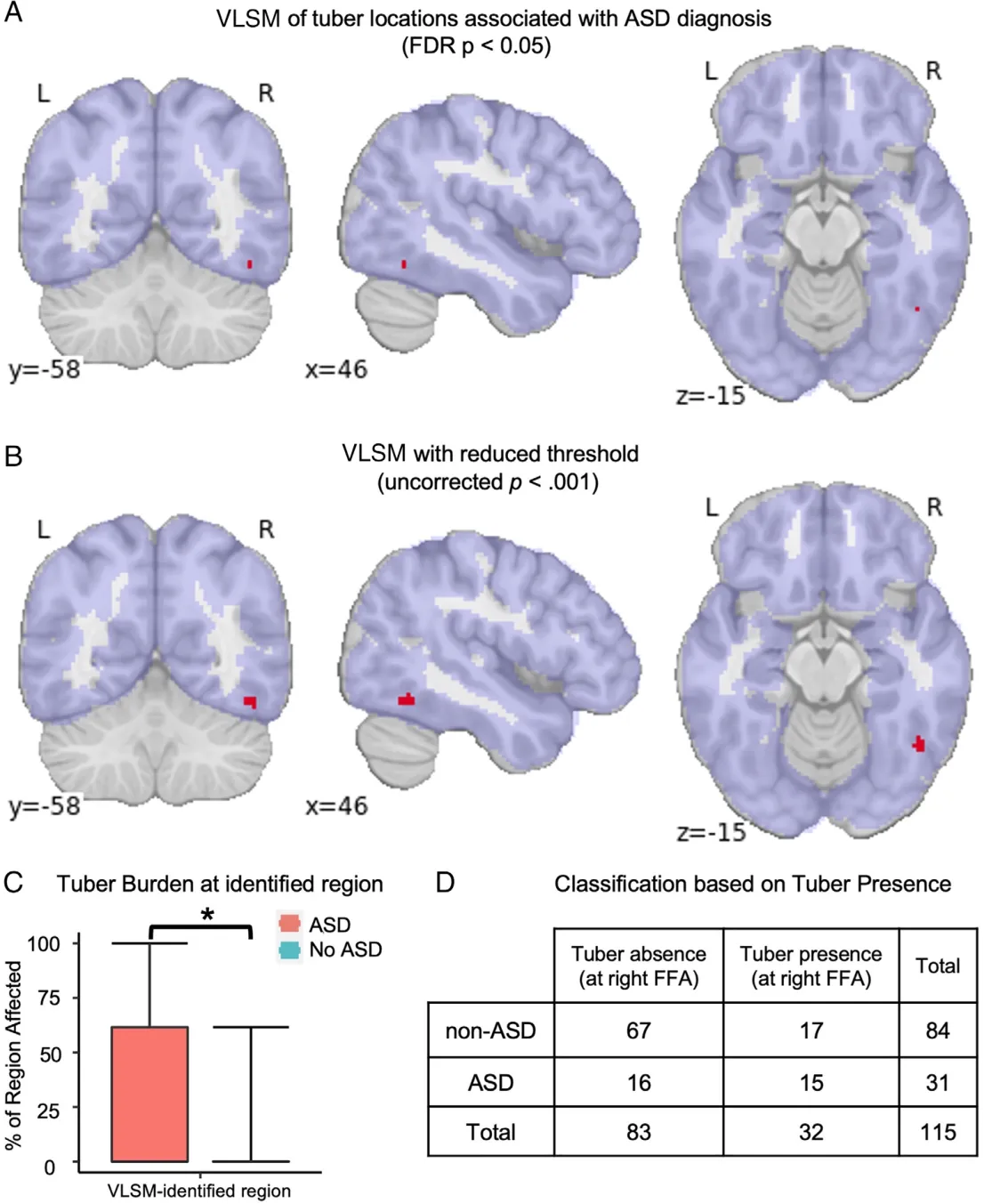 FIGURE 4: Voxelwise lesion symptom mapping (VLSM) of the association between tuber distribution and autism spectrum disorder (ASD) diagnosis found 5 significant voxels in the right temporal lobe that survive false discovery rate (FDR) multiple comparison correction, with a peak that survives familywise error correction (A). Decreasing the statistical threshold to confirm the shape of this peak and examine for other locations with less significant relationships only identified an expanded version of this cluster (B). For illustrative purposes only, tuber burden for this region is shown here (C) in the same format as in Figure 3, demonstrating a significantly higher tuber burden at this location compared to all other regions examined. Results are also shown from using a split-half model to generate this region with one half of the data and predicting ASD diagnosis in the other half (and vice versa). A standard clinical confusion matrix is shown (D), from which accuracy, false positive and negative rates, and positive and negative predictive values can be calculated. FFA = fusiform face area; L = left; R = right.