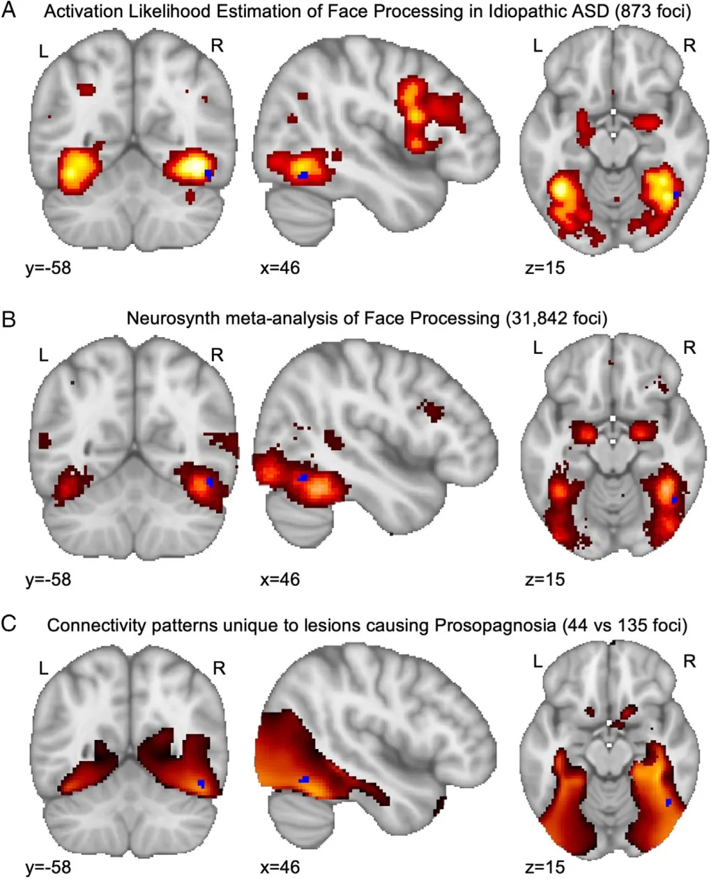 FIGURE 5: The voxelwise lesion symptom mapping-identified region (shown in blue) is consistent with the localization of face processing differences in nonsyndromic autism spectrum disorder (ASD), as demonstrated by an activation likelihood estimation map of “face processing” in ASD comprising 873 foci across 24 studies (A), and with face processing in general, as demonstrated by a Neurosynth meta-analysis of 31,842 activation coordinates from 896 studies (B). This region is also consistent with connectivity to lesions causing sudden onset prosopagnosia, here compared to a set of control lesions to demonstrate connectivity specific to lesion-induced impairment of face recognition (C; adapted from Cohen et al65). L = left; R = right.
