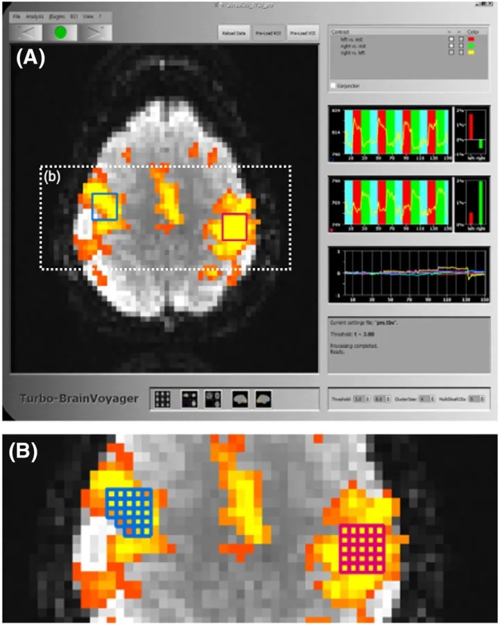 FIG 2 User interface of Turbo-BrainVoyager, which was used for real-time functional MRI (fMRI) analysis, region of interest (ROI) selection, ROI timeseries extraction, and transfer to the fMRI computer. Activation maps, ROI timeseries, and subject motion can be monitored on Turbo-BrainVoyager user interface shown on panel (A), and a zoomed-in view of the two exemplary ROIs selected at the end of the prefeedback scan is shown on panel (B). Blue and red voxels represent left and right ROIs, respectively. Note that ROIs are defined as the activated voxels (T > 3) within a cube consisting of 5 × 5 × 5 voxels
