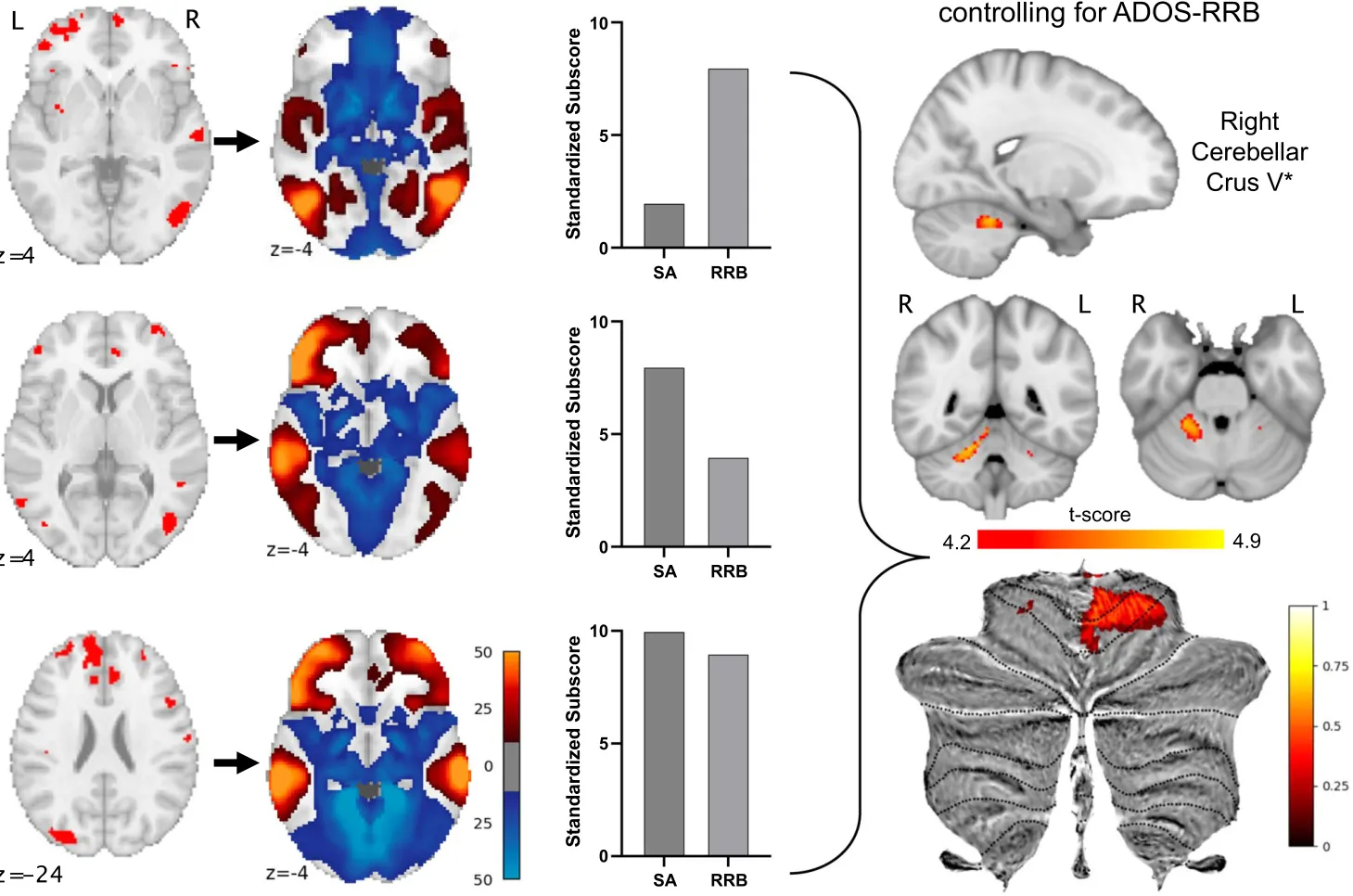 FIGURE 4 | Overview of lesion network mapping. All tuber voxels in totality for each patient were characterized as that patient's “lesion” (A) Permutation Analysis of Linear Models (PALM) was applied by comparing the functional connectivity between each lesion voxel against all other voxels in the brain of 1000 control participants from a connectome (B) while comparing with a measurement of interest, in this case ADOS subscores (C) The connectome used in this analysis was from the Adolescent Brain Cognitive Development (ABCD) Study, comprised of functional connectivity measured from 1000 individuals aged 9–10 years (see acknowledgments for reference). At the completion of those comparisons, a lesion network map was constructed with t‐statistics on each brain voxel. Maps of p‐values after family‐wise error (FWE) and false‐detection rate (FDR) corrections were then overlayed onto the t‐map at p > 0.95 (D) When applying PALM to our cohort's lesions along the ADOS‐SA score, we found a region of interest in the R cerebellar crus V area with the anatomical view above and the cerebellar flatmap view below. Note that the process of flattening a NIFTI ROI involves averaging of values, and therefore the range of t‐values plotted here is different than the direct result of PALM. Alt text: Composite figure with first column showing tuber locations in example axial brain slices of three patients, second column showing the functional connectivity map of each patient's tubers, third column showing ADOS testing subscores for SA and RRB, and last column showing the cerebellar region of interest plotted in three dimensions as well as on a cerebellar flatmap.
