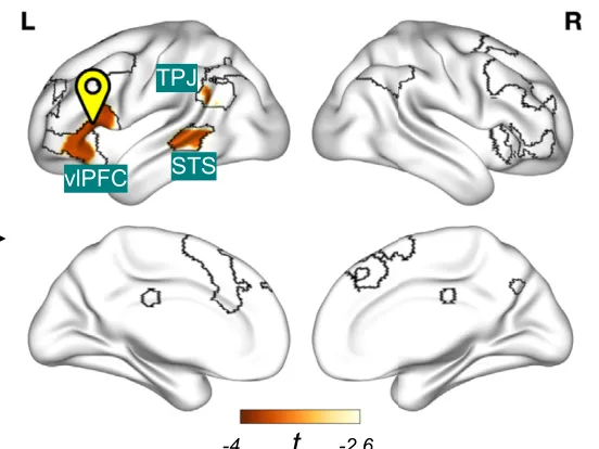 Figure 3. Lesion connectivity to the left ventrolateral prefrontal cortex (vlPFC) is associated with emotion regulation impairment. (A) Lesion locations from 3 representative patients. (B) Lesion connectivity maps for each patient, i.e., resting-state functional connectivity maps using individual lesions as seed regions combined with a normative connectome, shown here thresholded at t = 610. (C) Comparing these maps to managing emotion scores from each patient identified negative correlations with several regions including the left vlPFC, superior temporal sulcus (STS), and temporoparietal junction (TPJ) (voxelwise false discovery rate–corrected p , .05, k . 10). L, left; MNI, Montreal Neurological Institute; R, right.