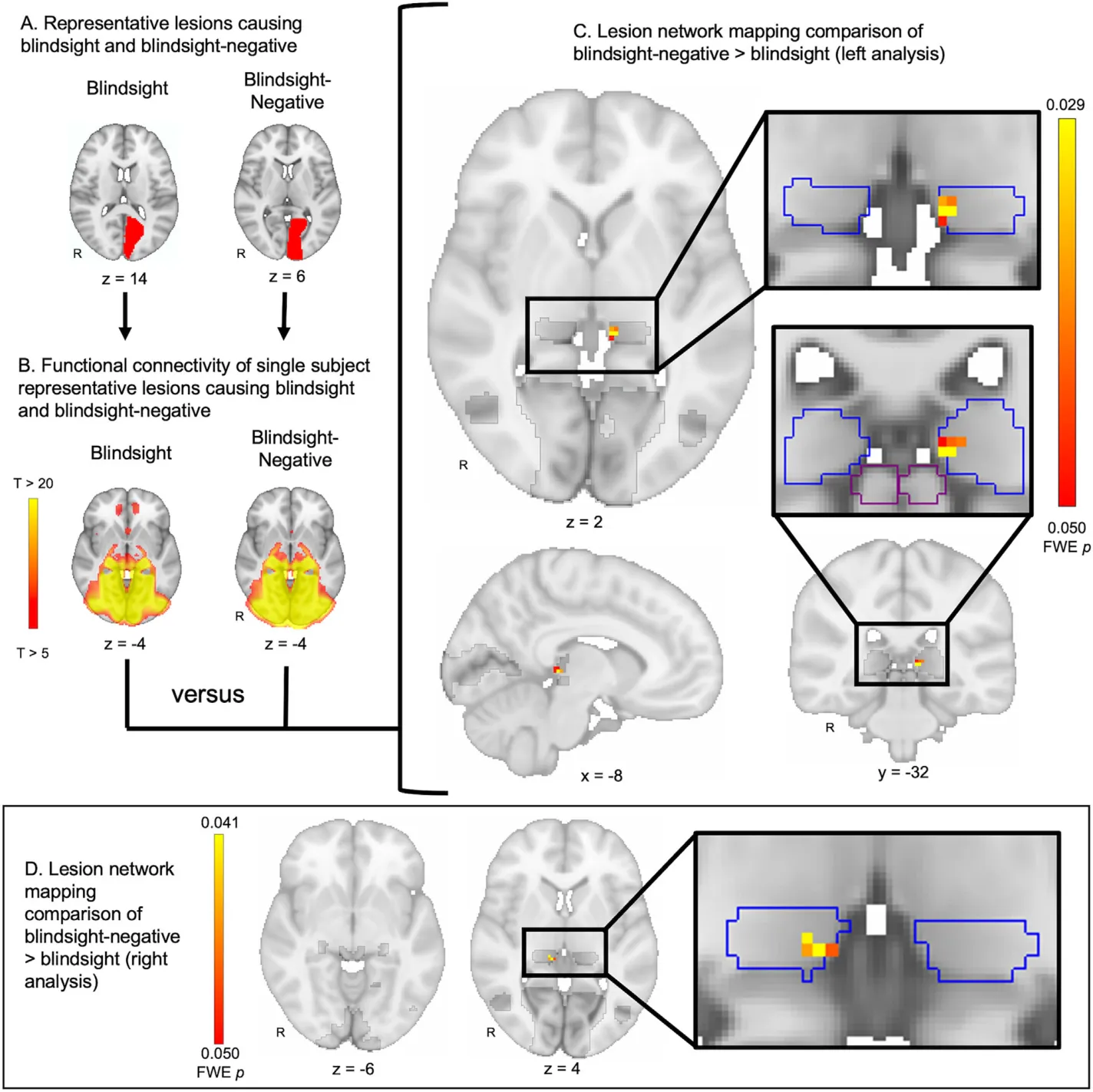FIGURE 2: Lesion network mapping of blindsight-negative versus blindsight. (A) Representative lesion locations from a blindsight and blindsight-negative patient. Lesions were consolidated into a single hemisphere for analysis (left analysis shown). (B) Connectivity between each lesion location and the rest of the brain was computed using a normative database of resting state functional connectivity from 1,000 healthy subjects. Pictured are the connectivity patterns derived from the two representative lesion locations shown in A. (C) Connectivity differences between lesion locations from blindsight-negative (n = 35) versus blindsight patients (n = 34) were identified using a 2-sample, voxelwise t test within a mask of regions previously implicated in blindsight (dark gray). Lesions in blindsight-negative patients showed greater functional connectivity to the medial pulvinar (pulvinar in blue outline) compared to lesions in blindsight patients. No voxels in the lateral geniculate nucleus, V1, V5, or superior colliculus (outlined in purple) were identified. Images were corrected for multiple comparisons using a voxel-based family wise error (FWE) rate of p ≤0.05. (D) The analysis shown in A–C was repeated, but consolidating lesion locations onto the right hemisphere rather than the left hemisphere, with identical findings. R = right.