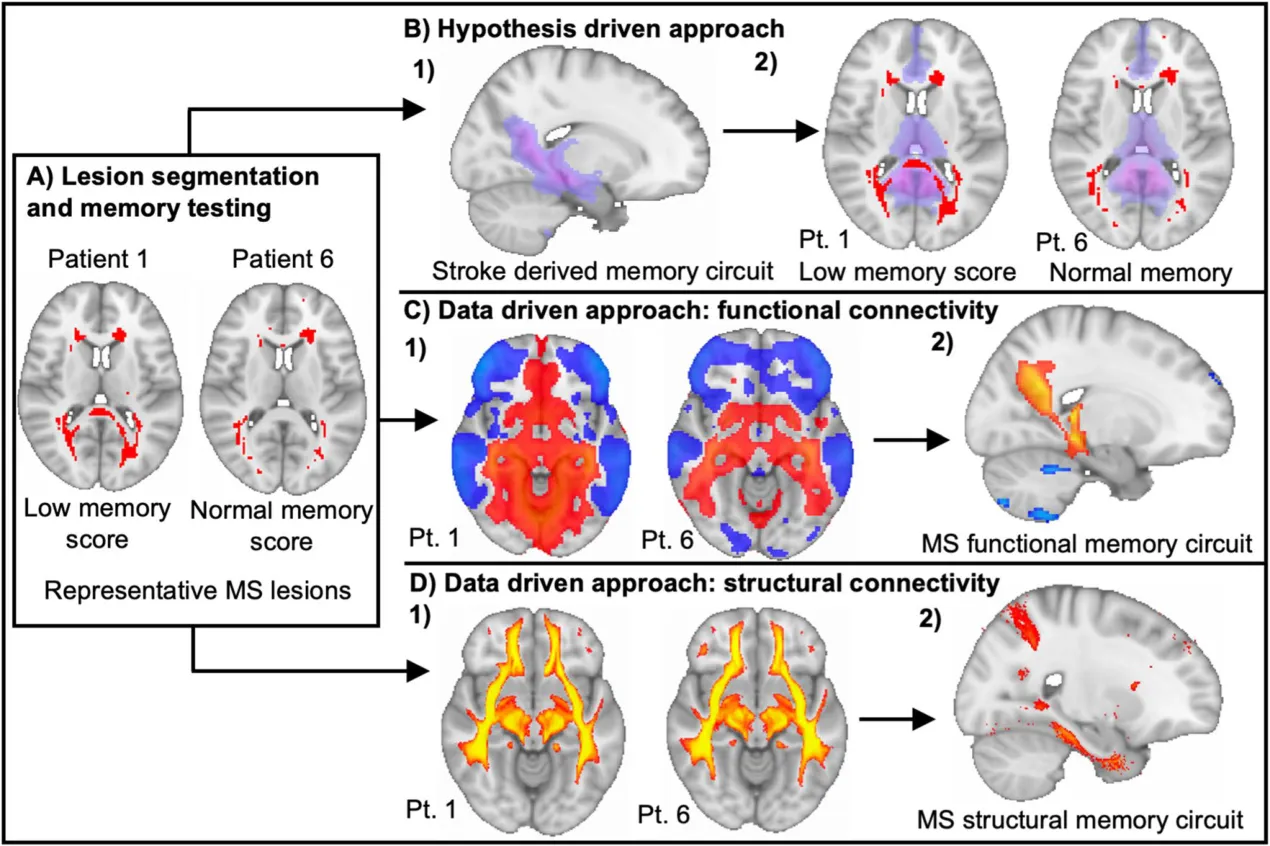 Fig. 1 Methodology to test if MS memory dysfunction is associated with disruption of memory circuits. A Structural imaging, lesion segmentation and memory assessment collected on patients with MS showing two representative lesion maps from a patient with normal and a patient with low memory score. Lesion maps and memory testing are used in subsequent analyses. B Determine if MS lesion damage to the a priori stroke-derived memory circuit associates with memory dysfunction. B1. Assess lesion overlap with stroke derived memory circuit and then B2. analyze association of MS lesion overlap with stroke derived memory circuit to memory scores. C Derive