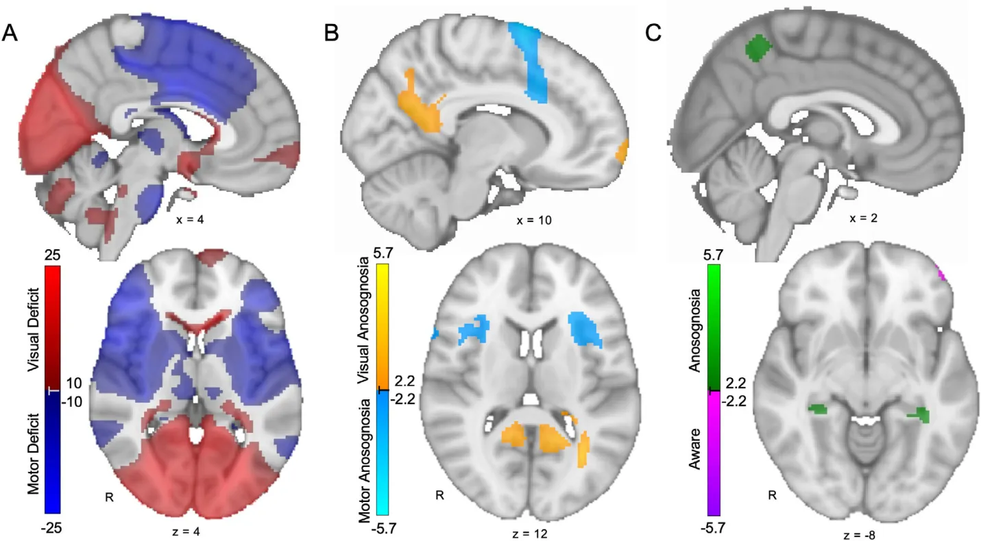 FIGURE 3: Modality-specific and cross-modal anosognosia networks. (A) Modality map showing lesion connections associated with vision deficits (red) versus motor deficits (blue) regardless of awareness. As expected, this map highlights domain-specific brain regions, such as the calcarine sulcus and pre-central gyrus. (B) Modality-specific anosognosia map showing lesion connections associated with visual anosognosia (warm colors) versus motor anosognosia (cool colors). Regions more specific for visual anosognosia include the posterior cingulate/inferior precuneus. Regions more specific for motor anosognosia include the anterior insula/frontal operculum and supplementary motor area/anterior cingulate. (C) Cross-modal anosognosia map showing lesion connections associated with anosognosia (green) versus awareness of deficits (purple) across both vision and motor domains. Regions in the general anosognosia network include the bilateral hippocampi and bilateral superior precuneus. All voxels shown are false discovery rate p < 0.05 (note that panel A is shown at a higher threshold of T > 10 and T < 10 to better highlight the most significant results).