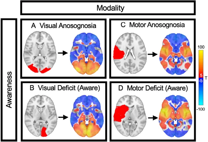 FIGURE 2: Method for identifying domain specific and crossmodal networks for awareness. We analyzed 4 groups of lesions associated with (A) visual anosognosia (n = 24), (B) visual deficit with awareness (n = 69), (C) motor anosognosia (n = 95), and (D) motor deficit with awareness (n = 79). Each lesion location (red) was mapped to a common brain atlas (left image). Functional connectivity between each lesion location and all other brain voxels was computed using a large functional connectome, generating a lesion network map for each case (right image). Positive connections are shown in warm colors, and negative connections are shown in cool colors. These 267 lesion network maps were entered into a single voxelwise analysis of variance (ANOVA; modality  awareness) to generate 3 brain maps: (1) a “modality map” comparing visual deficit versus motor deficit (regardless of awareness), (2) a “modality-specific anosognosia map” based on the interaction between modality and awareness, and (3) a crossmodal “awareness map” comparing anosognosia versus awareness (regardless of the deficit).