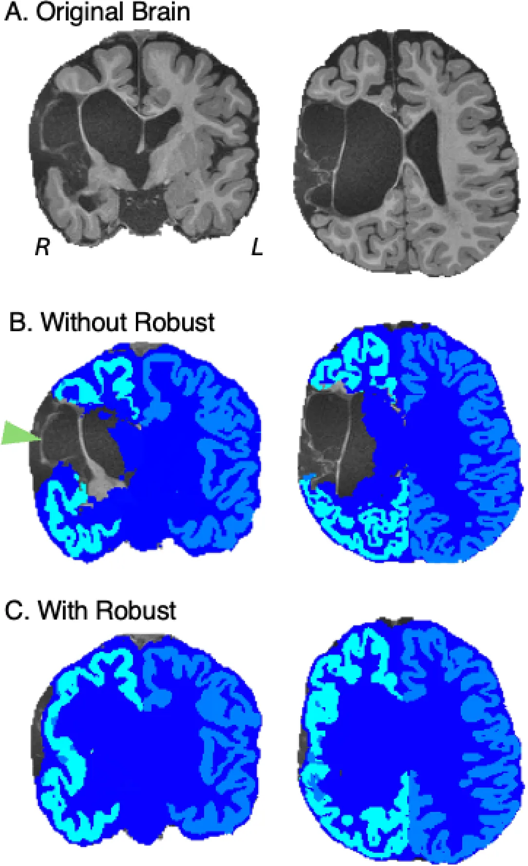 Fig. 2. Representative brain segmentation created using SynthSeg v2.0 with and without the robust setting for a patient with a large cystic lesion (A). Note that without the robust setting (B), there is a lack of cortical ribbon delineation through the area of cystic lesion in the right hemisphere, while using the robust setting (C) generates a simulated cortical ribbon representation that - while not an accurate representation of the patient’s current anatomy - allows for boundaryregistration algorithms to be utilized.