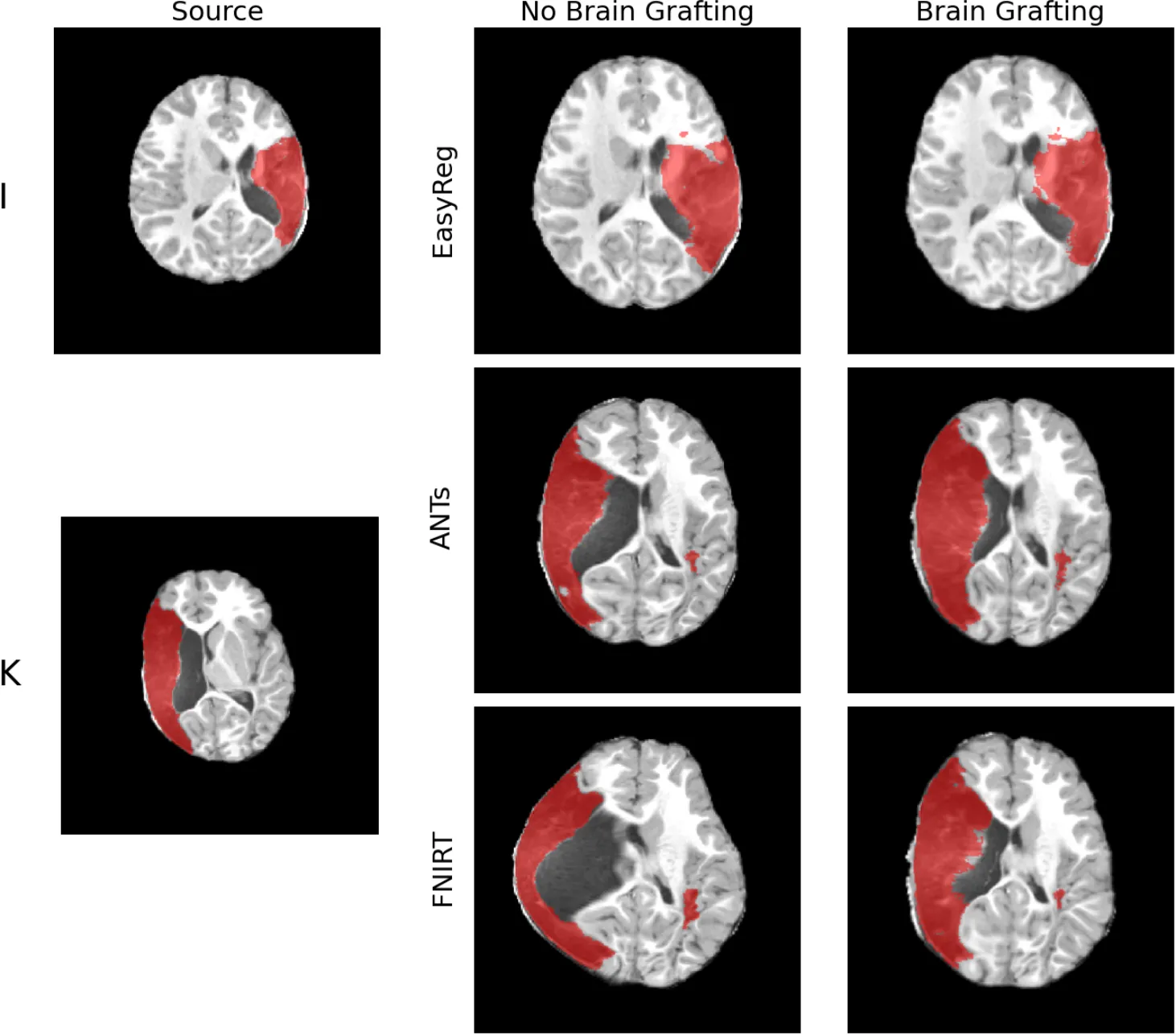 Fig. 10. Selected brain grafting comparison examples. Patient I with EasyReg (top): brain grafting appears to reduce accuracy; note the slightly larger posterior left lateral ventricle and incorrectly reduced lesion volume with brain grafting compared to without brain grafting. Patient K with ANTs (middle): brain grafting appears to improve accuracy; note the smaller right lateral ventricle and more anatomically accurate posterior-occipital white matter with brain grafting compared to without brain grafting. Patient K with FNIRT (bottom): brain grafting appears to improve accuracy; note the smaller right lateral ventricle and more anatomically accurate brain edge.