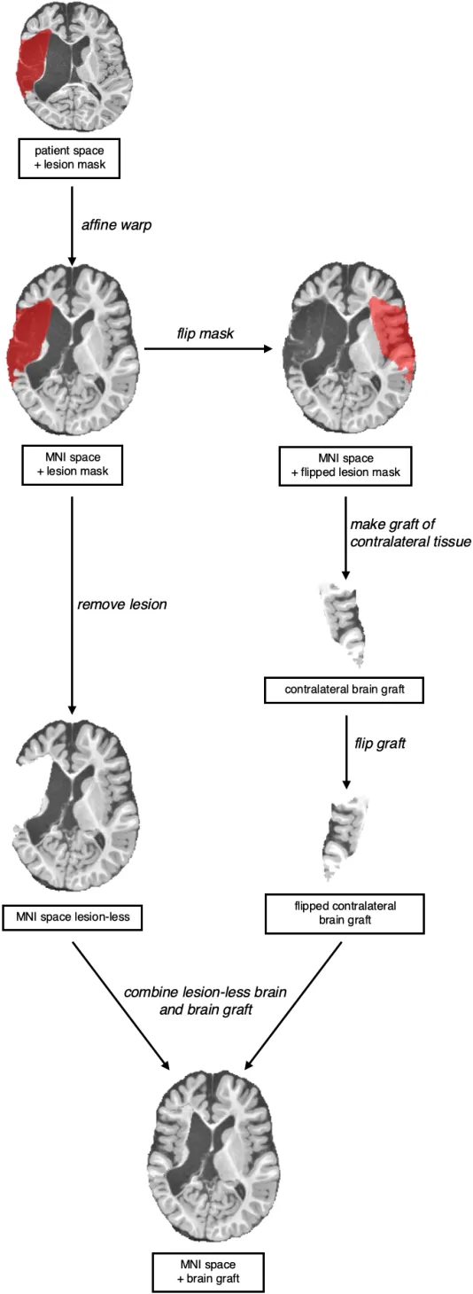 Fig. 3. Brain grafting procedure. The patient’s structural image and associated lesion mask are affine warped to template space. The mask is then flipped onto the contralateral hemisphere and used to extract a “graft” of healthy tissue. In parallel, the lesioned area is removed from the structural image. The brain graft is then flipped back to the ipsilateral side and combined with the prepared structural image, replacing the area of lesioned tissue. This “corrected” image is then normalized by the three registration software packages.