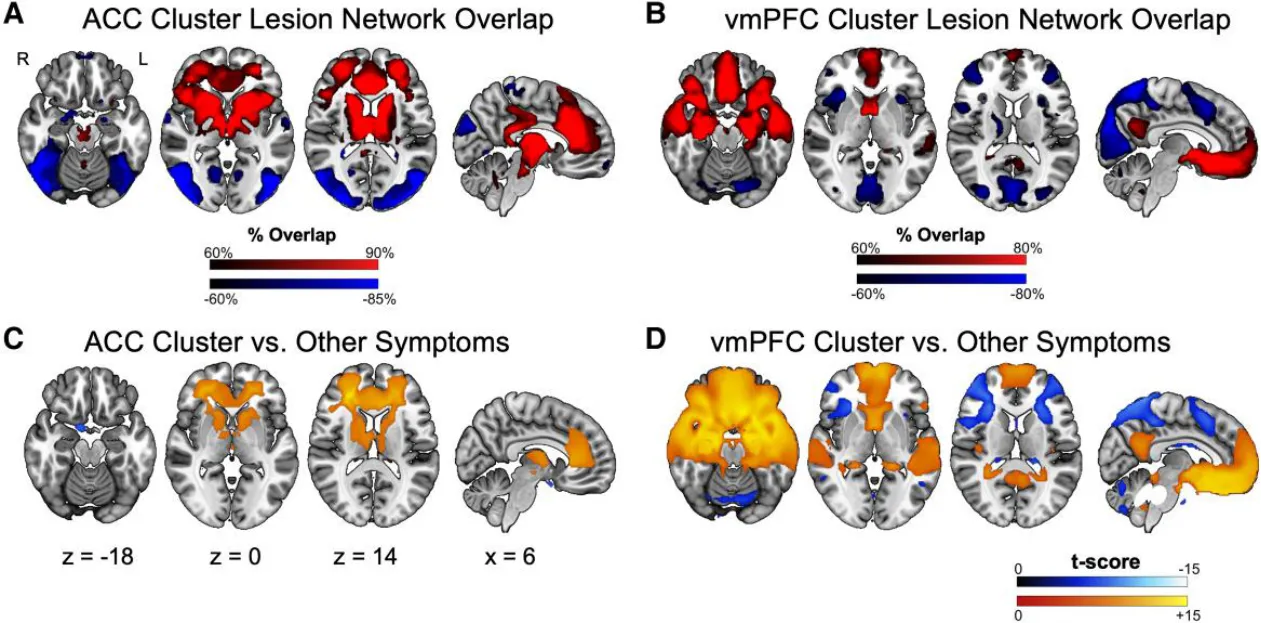 Figure 2 Lesion network localization of each cluster. (A) Voxels functionally connected at least 60% of lesions in the ACC Cluster (n = 14 lesions). (B) Voxels functionally connected at least 60% of lesions in the vmPFC Cluster (n = 47 lesions). (C) Two-sample t-test comparing functional connectivity of the ACC Cluster (n = 14 lesions) to the large cohort of lesions causing other symptoms (n = 716 lesions) (FWE corrected P < 0.05). (D) Two-sample t-test comparing functional connectivity of the vmPFC Cluster (n = 47 lesions) to the large cohort of lesions causing other symptoms (n = 716 lesions) (FWE corrected P < 0.05).