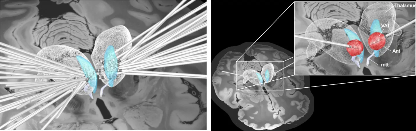 Figure 6. Relevance to deep brain stimulation (DBS). (A) DBS electrodes from 25 patients with drug-resistant epilepsy exhibit minor variability in electrode location within the anterior thalamus. (B) The stimulation site for each patient was determined by calculating the volume of activated tissue (VAT) using personalized stimulation parameters. (C) Functional connectivity between DBS stimulation sites and the lesion network node significantly predicted the changes in irritability before and after DBS treatment. (D) Notably, this prediction was specific to irritability because the same functional connectivity failed to predict any of the remaining 20 symptoms assessed in Beck Depression Inventory II. The red bar represents significant prediction, whereas blue bars represent nonsignificant prediction. *p , .05. Ant, anterior nucleus of thalamus; mtt, mammillothalamic tract.