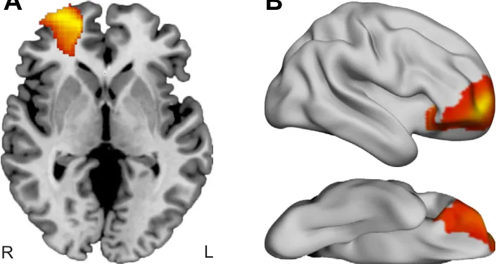 Figure 3. Lesion network mapping analysis identified a focal region in right prefrontal cortex whose connection was positively associated with aggression. This region, displayed on both the brain slice (A) and brain surface (B), is referred to as lesion network node. The highlighted region was corrected for multiple comparisons using permutation-based 2-sided cluster-level familywise error p (pFWE) , .05, with a cluster-forming threshold at voxel-level p , .001. L, left; R, right.
