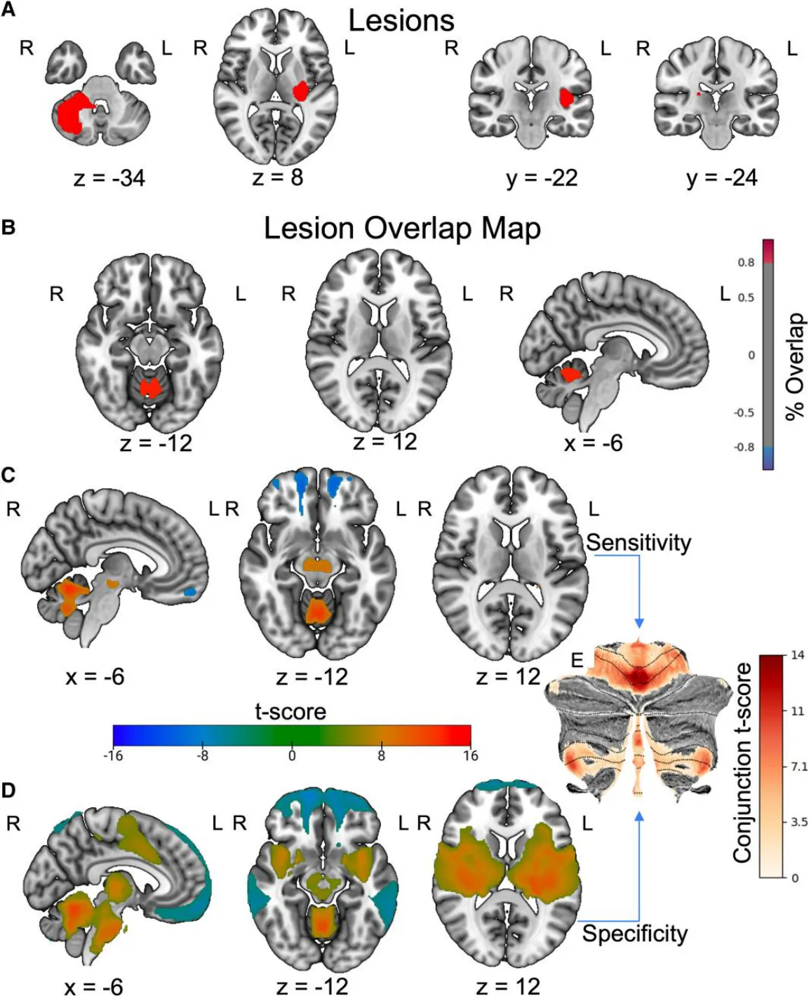 Figure 2 Lesion network localization of sensory sensitivity. (A) Representative lesions (n = 61) causing sensory perception changes, demonstrating heterogeneity of lesion location. (B) Lesion overlap map (90%, T > 7). (C) One-sample t-test of lesion connectivity (family-wise error (FWE) corrected P < 0.05). (D) Functional connectivity specific to lesions causing sensory changes compared to a large cohort of lesions causing other symptoms via two-sample t-test (FWE corrected P < 0.05). (E) Cerebellar regions of interest present in both the one- and two-sample t-tests.