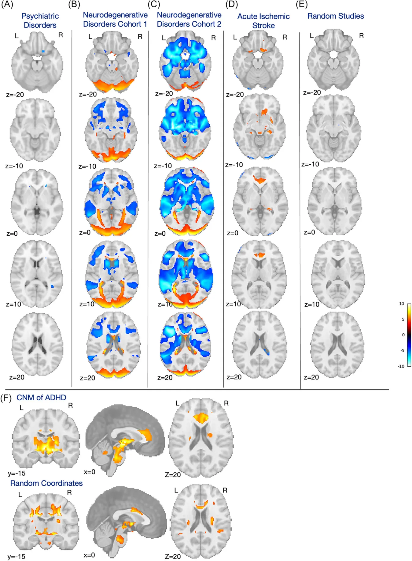 FIGURE 5 | Comparison with control groups. The two‐sample t test between CNM of ADHD and psychiatric disorders (A) is largely nonsignificant, while the two‐sample t tests between two separate neurodegenerative disorder cohorts (B–C) largely reflect increased consistency in the two control cohorts. Comparison against lesion network mapping of acute stroke solely revealed the ACC (D), while comparison against a random set of atrophy studies was nonsignificant (E). For visual comparison, we show our CNM of ADHD one‐sample t test results (F, upper row) compared with the same analysis done with random coordinates (F, lower row). ADHD, attention‐deficit/hyperactivity disorder; CNM, coordinate network mapping; PALM, Permutation Analysis of Linear Models.