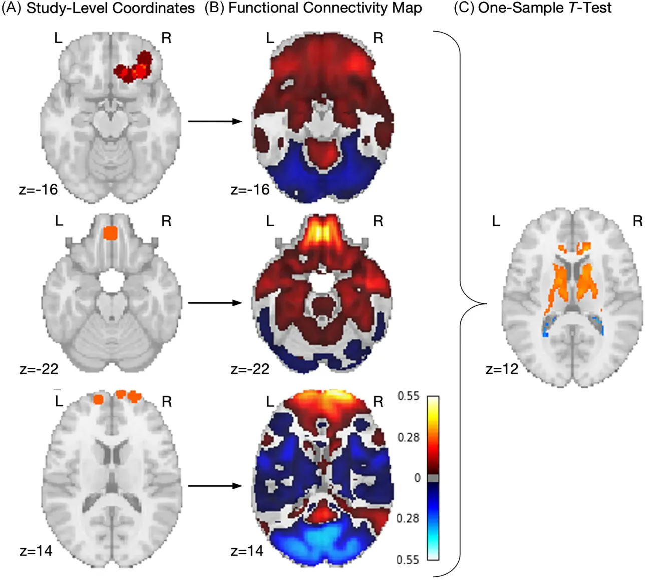FIGURE 1 | Coordinate network mapping methods and results. In this study, we first created experiment‐level maps of the coordinates (A), which we then used to calculate functional connectivity maps using a pediatric normative connectome (B). Finally, we conducted a one‐sample t test with permutation testing and multiple comparisons corrected to identify which regions were significantly and consistently connected to the original coordinates (C).