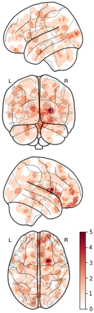 FIGURE 3 | Original coordinates. This map shows the distribution of the original coordinates collected from the 38 papers used in this meta‐ analysis. Although the coordinates were widespread across the brain, a maximum of only five studies contained the same overlapping coordinate.